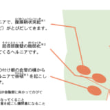 鼠径ヘルニア（脱腸）について～子どもだけじゃない。成人も要注意～