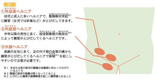 鼠径ヘルニア（脱腸）について～子どもだけじゃない。成人も要注意～