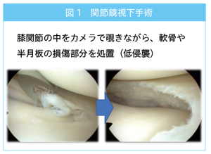 関節鏡視下手術