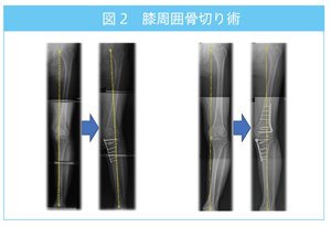 膝周囲骨切り術