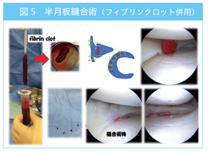 半月板縫合術（フィブリンクロット併用）