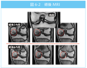 術後MRI