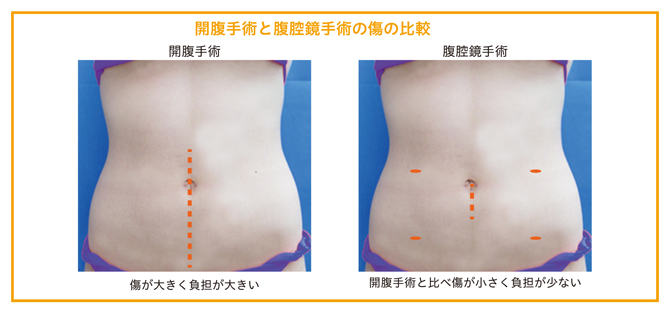 開腹手術と腹腔鏡手術の傷の比較