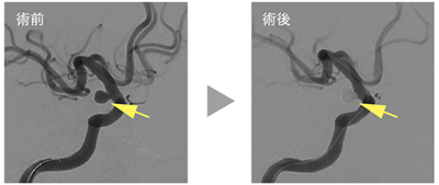 常に最高のチーム力で挑む脳血管内治療 広報誌あすなろ