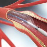 末梢動脈疾患 PAD：Peripheral Arterial Disease