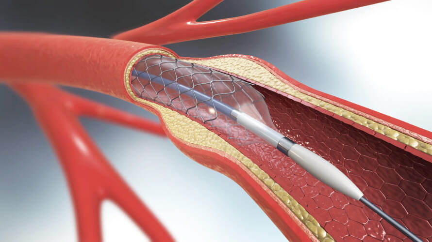 末梢動脈疾患 PAD：Peripheral Arterial Disease
