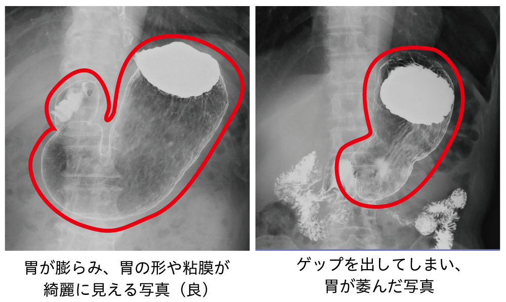 胃 透視 で わかる こと