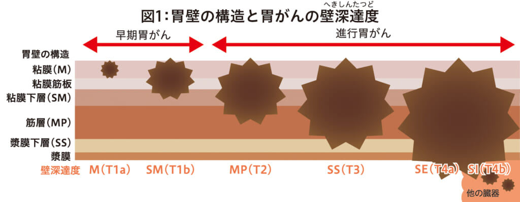 胃がんのはなし │ 広報誌あすなろ