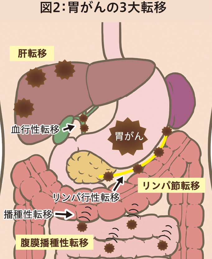 胃がんのはなし │ 広報誌あすなろ