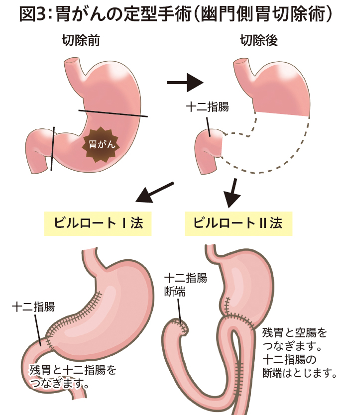 胃がんのはなし │ 広報誌あすなろ