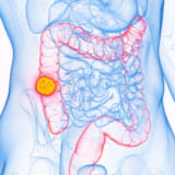 大腸がんで死なないために