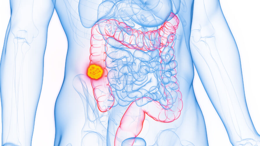 大腸がんで死なないために